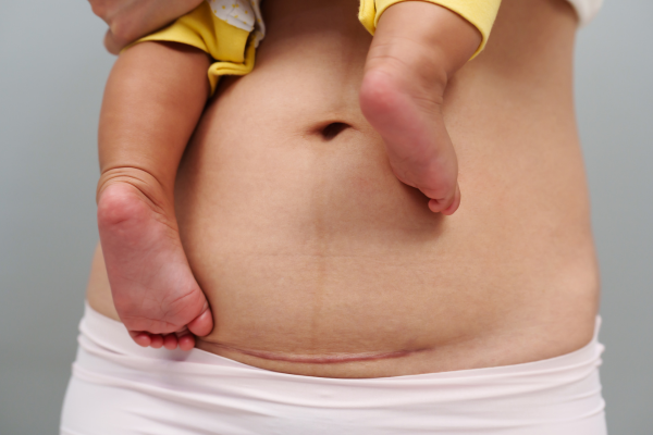 Normal & C-section Delivery